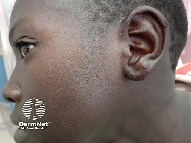 Contact allergy on the face and ears due to a herbal soap constituent