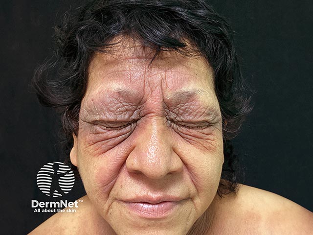 Lichenified contact allergy on the lids due to paraphenylenediamine (PPD) in a hair dye