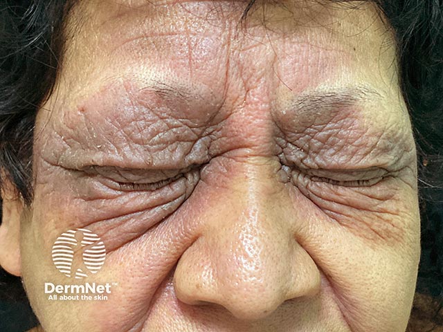 Lichenified contact allergy on the lids due to paraphenylenediamine (PPD) in a hair dye