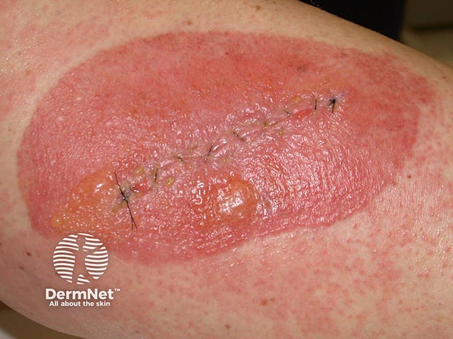 Bullous contact dermatitis due to 'tinc benz co' (Friar's balsam) applied to a surgical wound