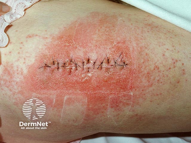 Bullous contact dermatitis due to 'tinc benz co' (Friar's balsam) applied to a surgical wound