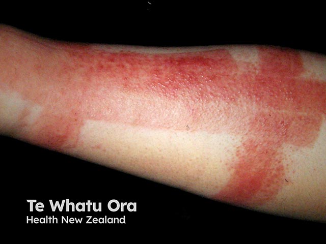Allergic contact dermatitis due to an adhesive in orthopaedic strapping