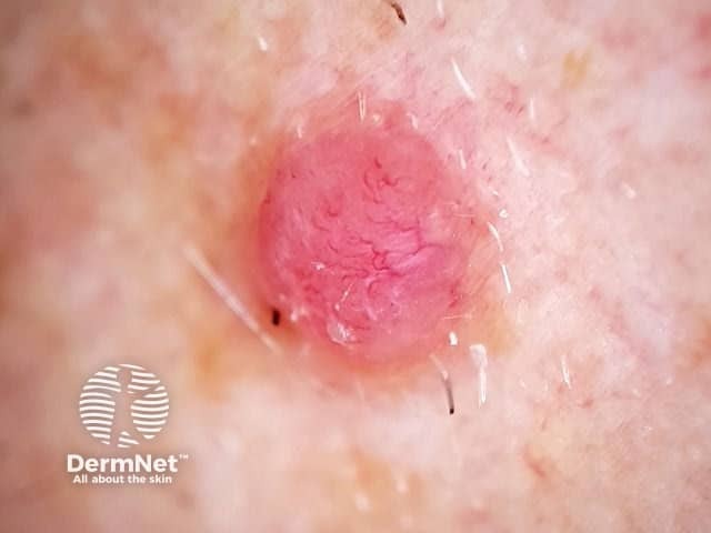 Amelanotic melanoma dermoscopy