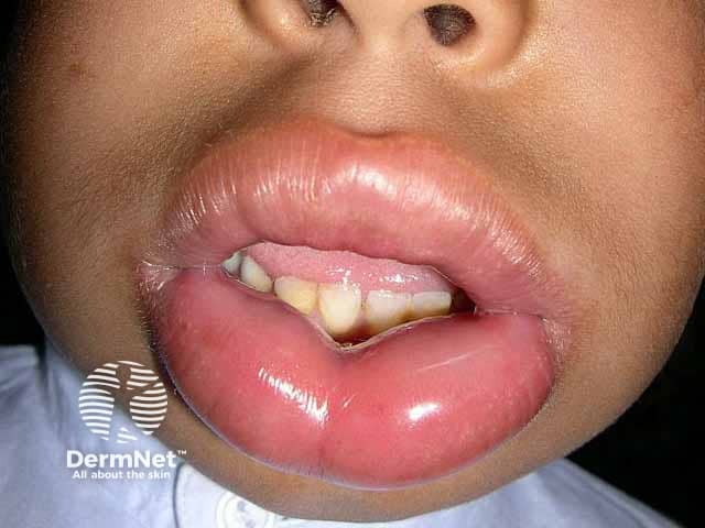 Severe lip angioedema