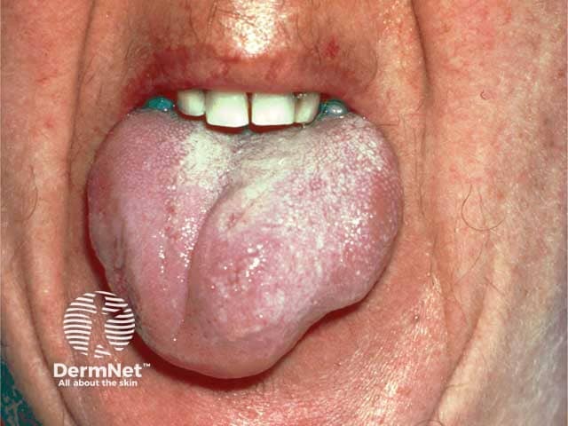 Severe lingual angioedema in acquired C1 esterase inhibitor deficiency