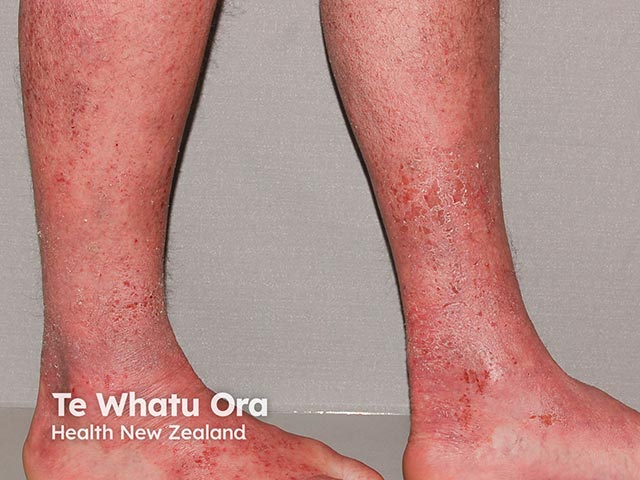 Extensive atopic dermatitis on the legs