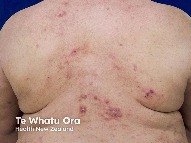 Excoriated and lichenified atopic dermatitis on the back