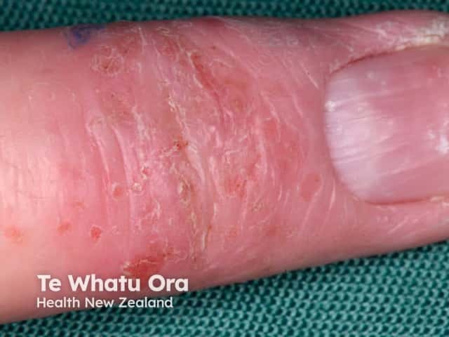 Longitudinal nail ridging and pitting with atopic dermatitis of the distal finger