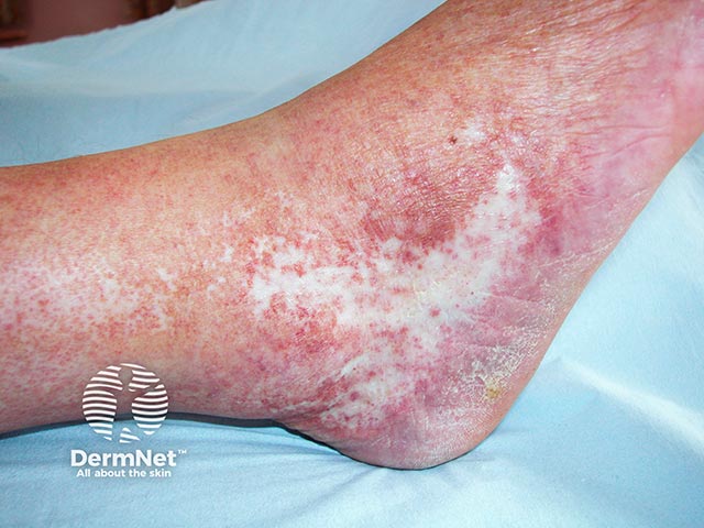 Ivory-white scars with dotted vessels in atrophie blanche