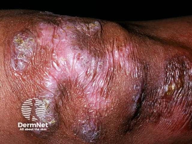 Mycobacterium marinum infection