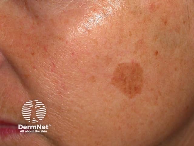 Freckle before cryotherapy