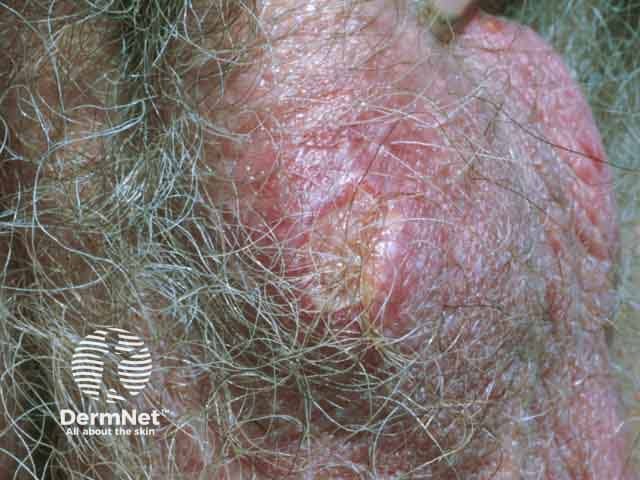 Scrotal aphthous ulcer in Behcet disease