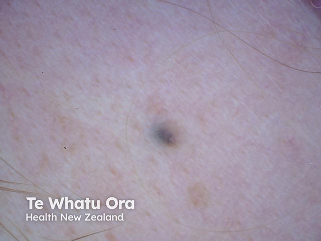 Dermoscopy of a blue naevus