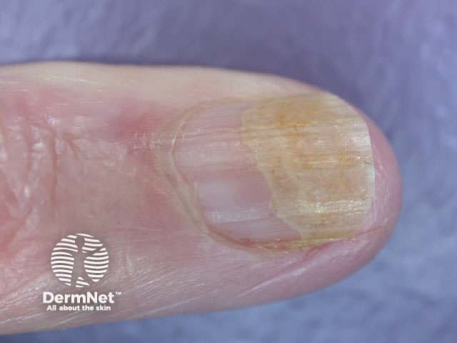 Candida infection and onycholysis