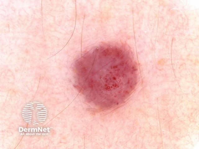 Cherry angioma dermoscopy