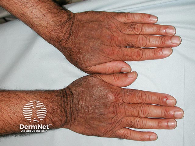 Chronic actinic dermatitis