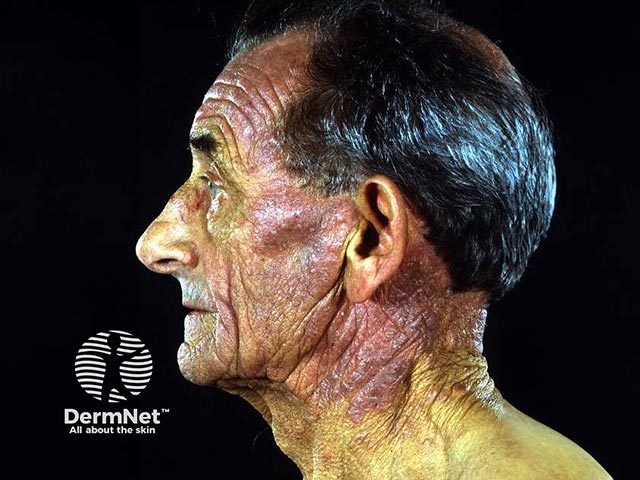 CAD affecting the face and neck