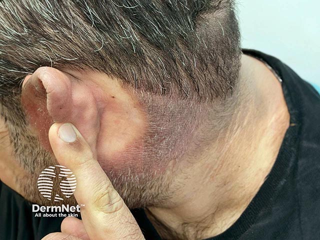 CAD in a younger Asian man - the retroauricular sparing is marked