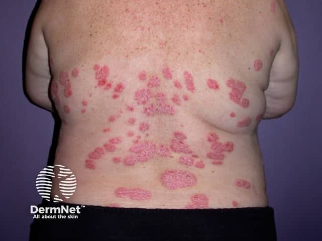 Chronic plaque psoriasis in a lady with a BMI of 34