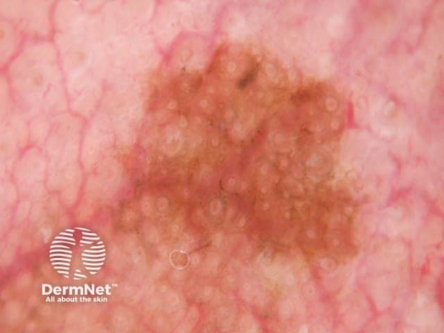 Dermoscopic view of lentigo maligna showing pigmented circles and the isobar sign