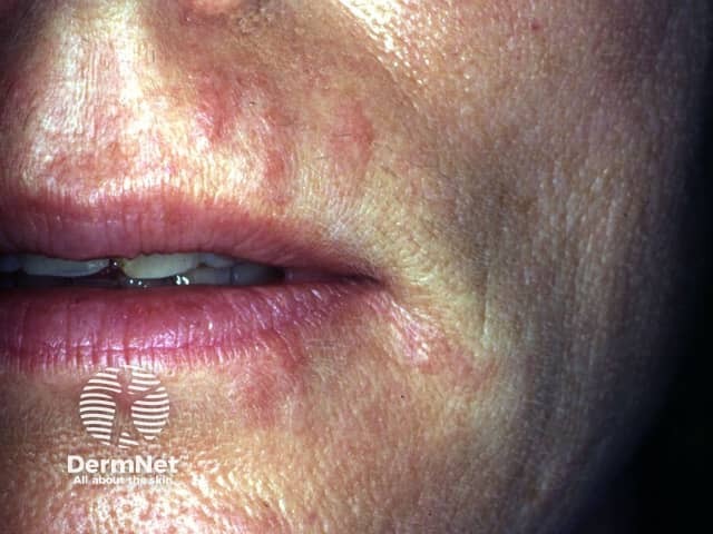 Allergy to collagen injected