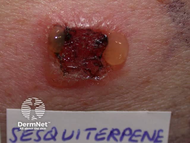 +++ reaction to compositae mix