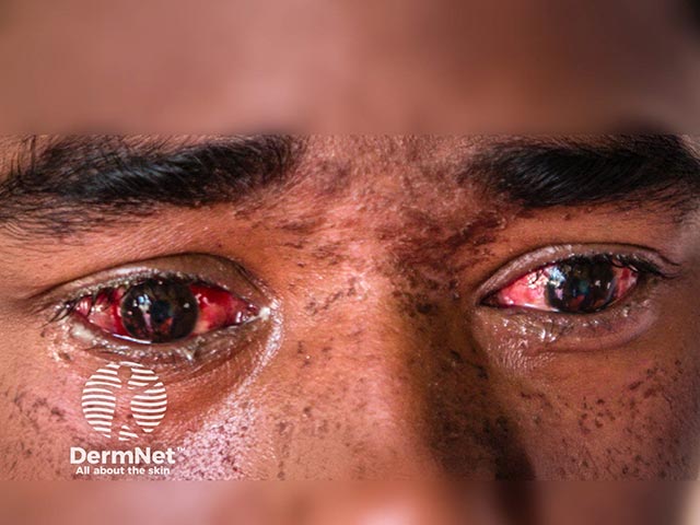 Conjunctivitis from measles