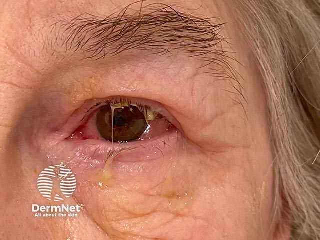 Bacterial conjunctivitis