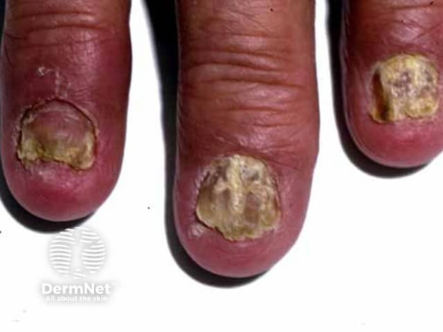 Nails in psoriasis
