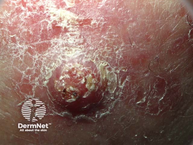 Squamous cell carcinoma