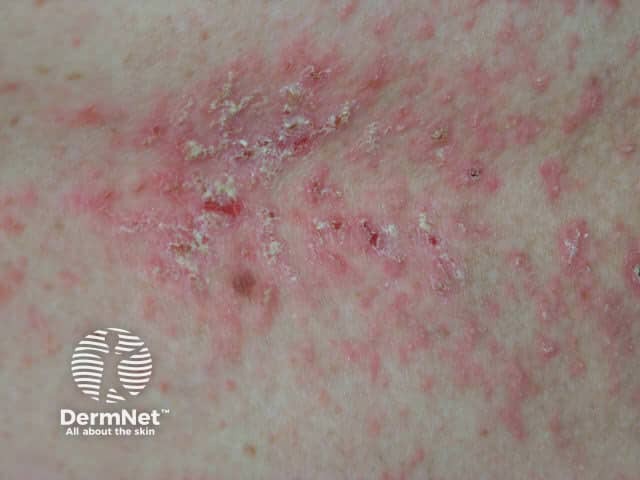 Darier disease on the mid-back
