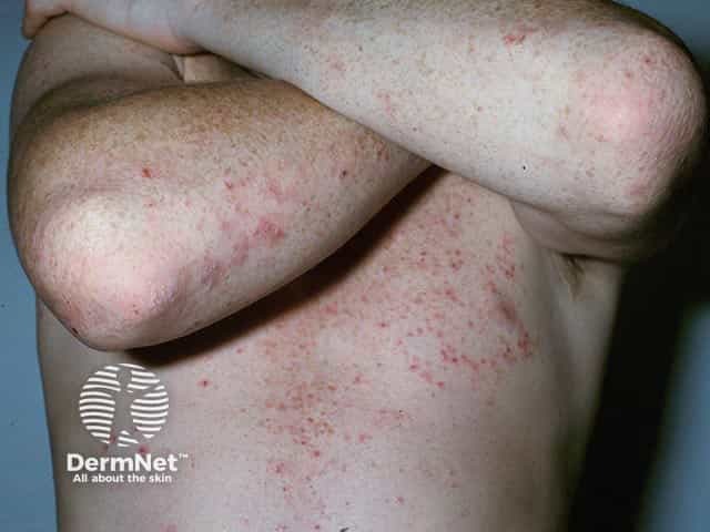 Elbow and truncal dermatitis herpetiformis