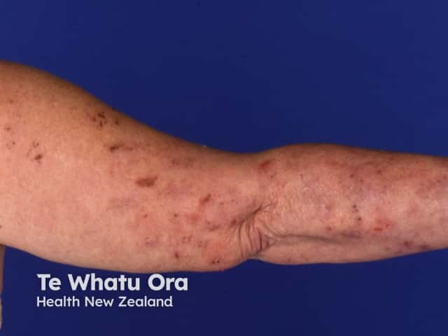 Dermatitis herpetiformis