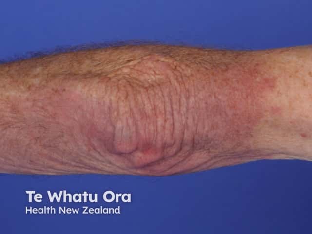 Gottron sign over the elbow