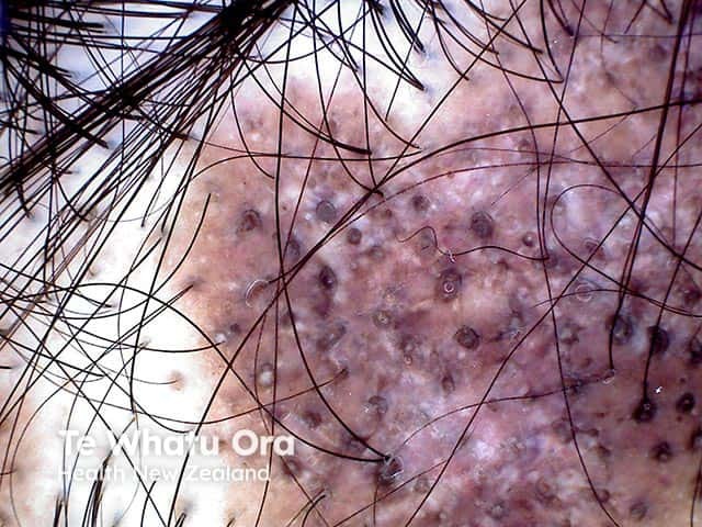 Scarring alopecia with follicular plugging in discoid lupus erythematosus