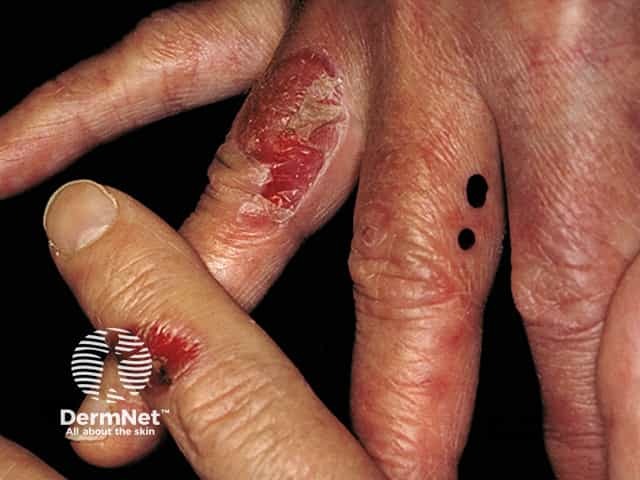 Epidermolysis bullosa acquisita