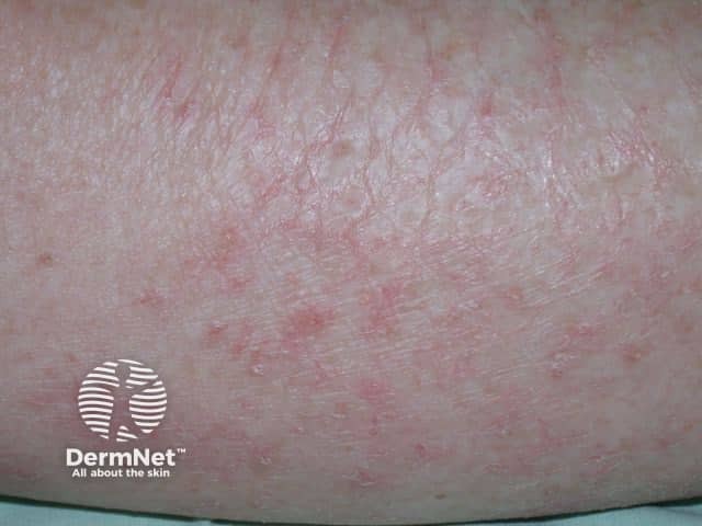 Dryness, redness, and scaling in postmenopausal asteatotic eczema