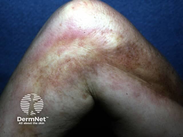 Indurated skin thickening causing limited joint mobility due to eosinophilic fasciitis