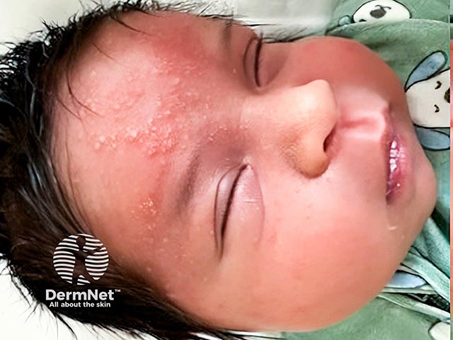 Sterile pustules on the face of a newborn; Tzanck smear of the pus showed numerous eosinophils confirming EPFI.