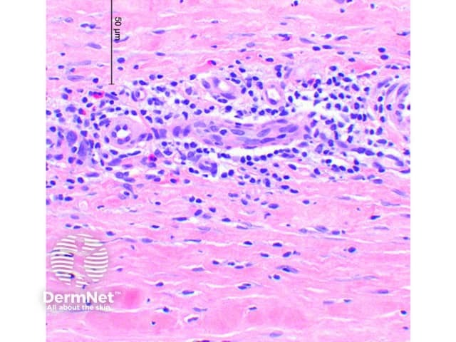 An inflammatory infiltrate with scattered eosinophils in the perimuscular fascia