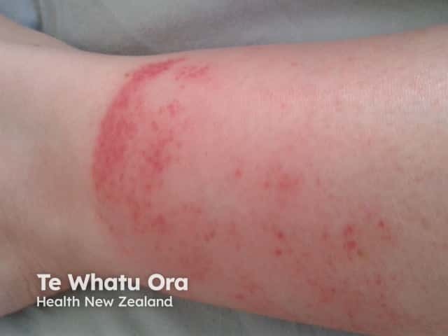 Exercise-induced capillaritis