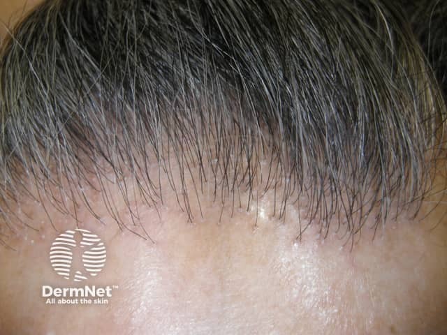Frontal fibrosing alopecia - most commonly develops in perimenopause