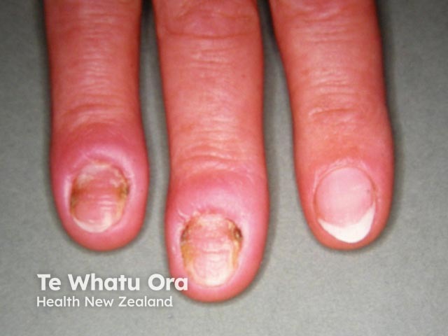 Chronic candida paronychia