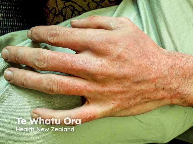 Hand eczema on the back of the hand - mixture of irritant factors in this atopic person