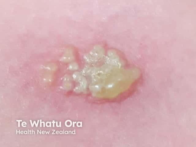 Pustule due to herpes simplex