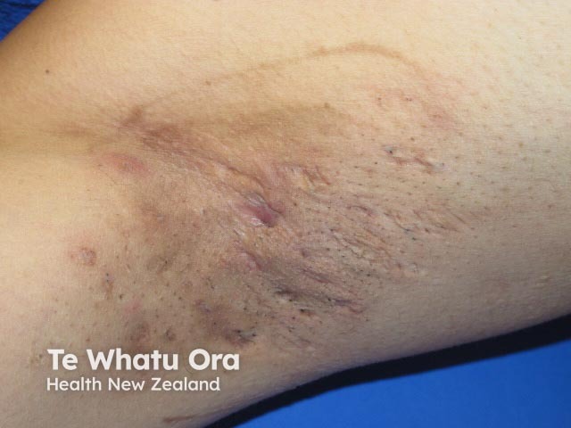 Hidradenitis suppurativa of axilla