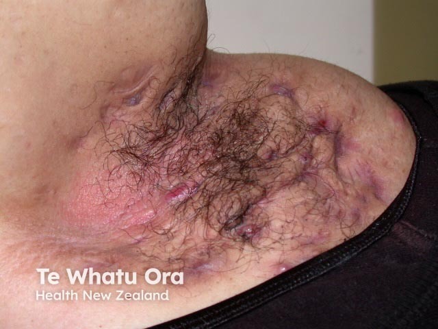 Axillary hidradenitis in an obese individual