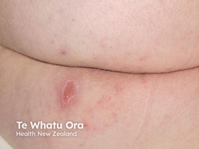 Hidradenitis suppurativa of buttocks