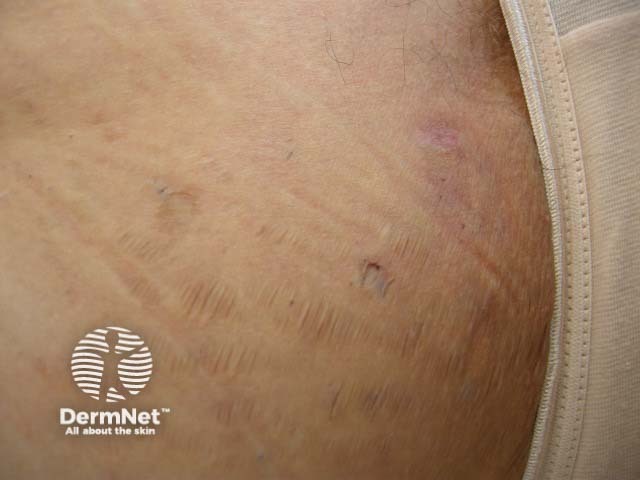 Scarring in hidradenitis suppurativa