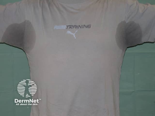 Excessive sweating in armpits